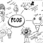 Polycystic Ovarian Syndrome: The Good, the Bad and the Hairy