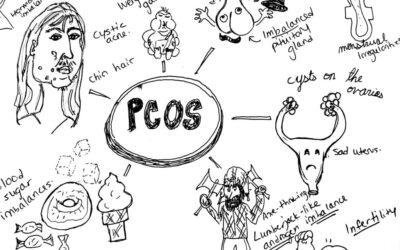 Polycystic Ovarian Syndrome: The Good, the Bad and the Hairy